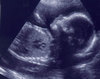  Un copil cu malformatii trebuie avortat?